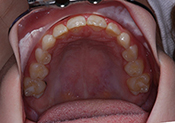 end phase I occlusal