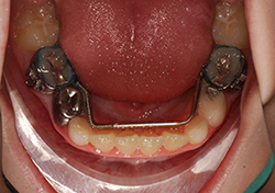 Expander on bottom jaw - an innovative solution for dental alignment